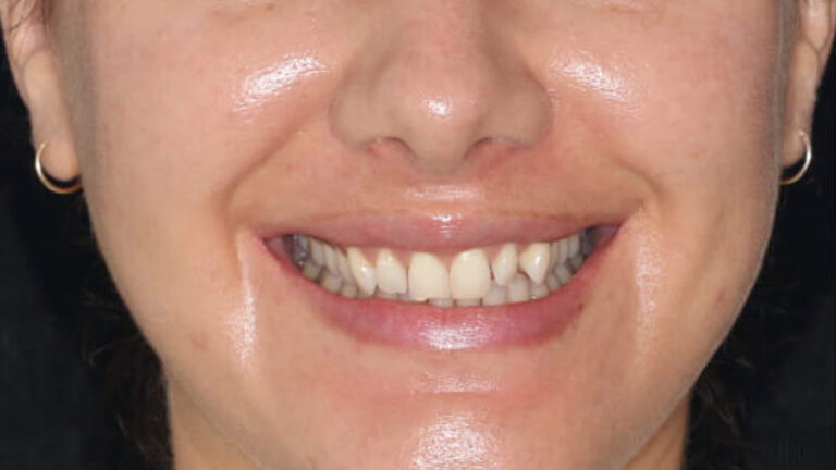 Before – Praesent sed neque turpis